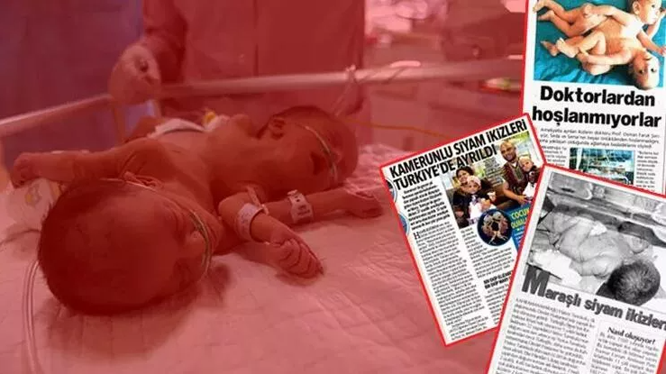 İki kafa ve üç kolla doğan bebekler şaşkına uğrattı… Merak edilenleri Türk doktor anlattı