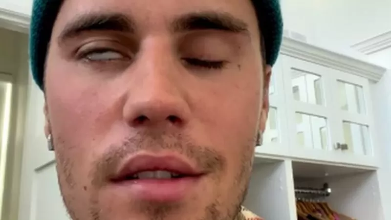 Justin Bieber’î etkileyen Ramsay Hunt sendromu nedir?