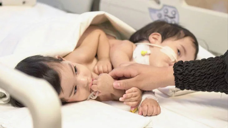 9 saat süren ameliyatla ayrılan Cezayirli bebeklerin durumu