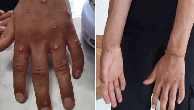Test sonucu bekleniyor! Türkiye’de maymun çiçeği alarmı