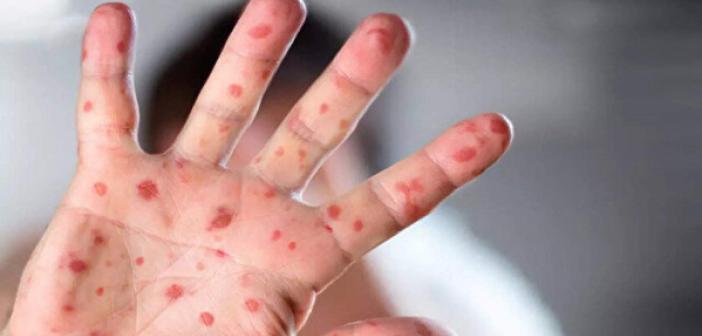 Maymun çiçeği vakaları 780’e yükseldi