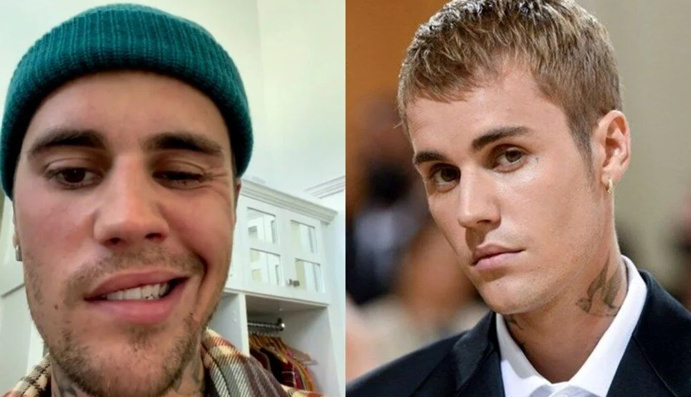 Justin Bieber yüz felci geçirdi
