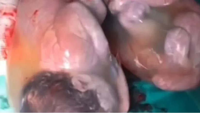 Görenler gözlerine inanamadı! 80 binde bir kez gerçekleşen mucize