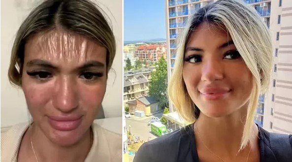 Güneş altında uyuya kaldı! Hayatının şokunu yaşadı