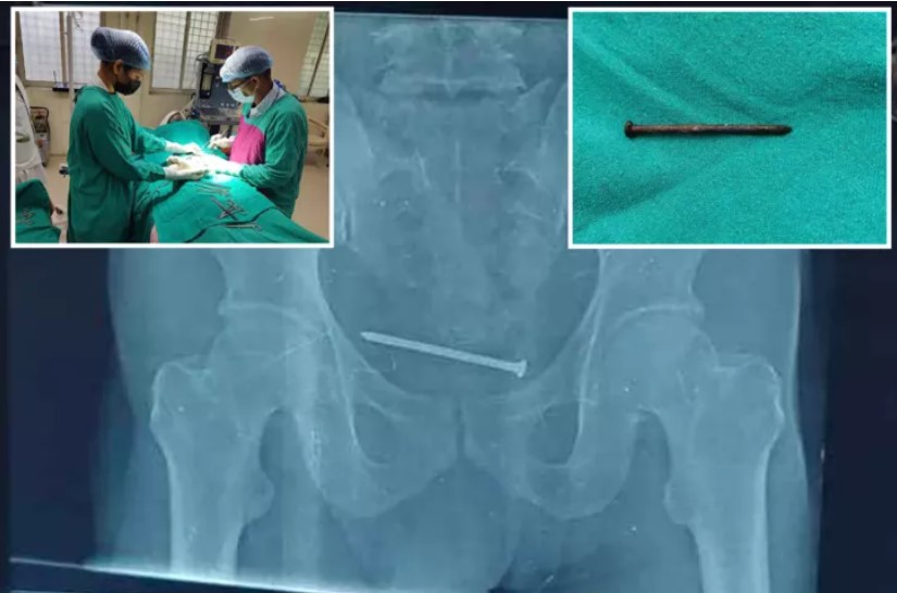 Doktorlar afalladı! 10 cm’lik paslı çivi çıktı