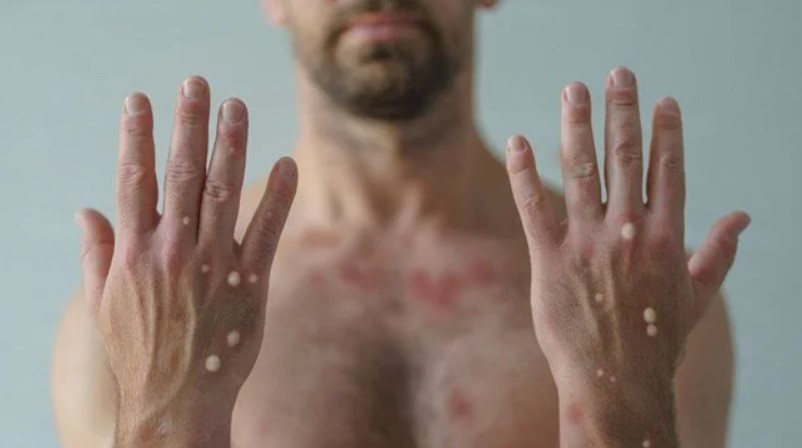 Maymun çiçeği, Covid-19 ve HIV’in aynı anda bulunduğu vaka tespit edildi