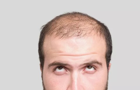 Saç dökülmesini hızlandırıyor, kelliğe neden oluyor