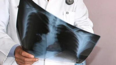 Akciğer embolisi nedir?
