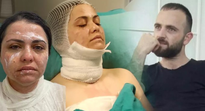 Eski eşe kimyasal maddeli saldırı