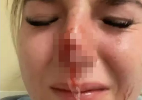 Köpeği sevmek için yanına yaklaştı! Aniden burnunu koparttı…