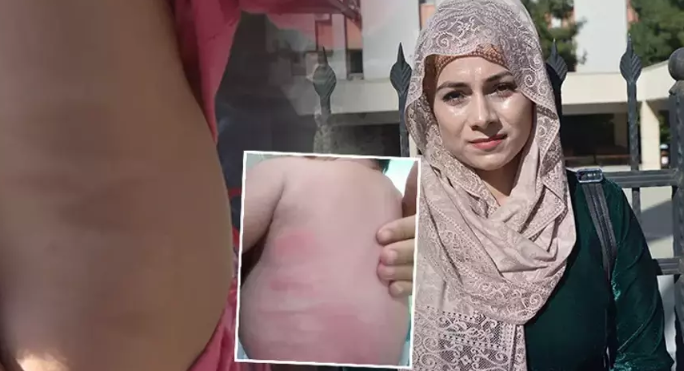 Hastanede yatan bebekte yanık izleri! ‘Doktor raporu’ istan ettirdi