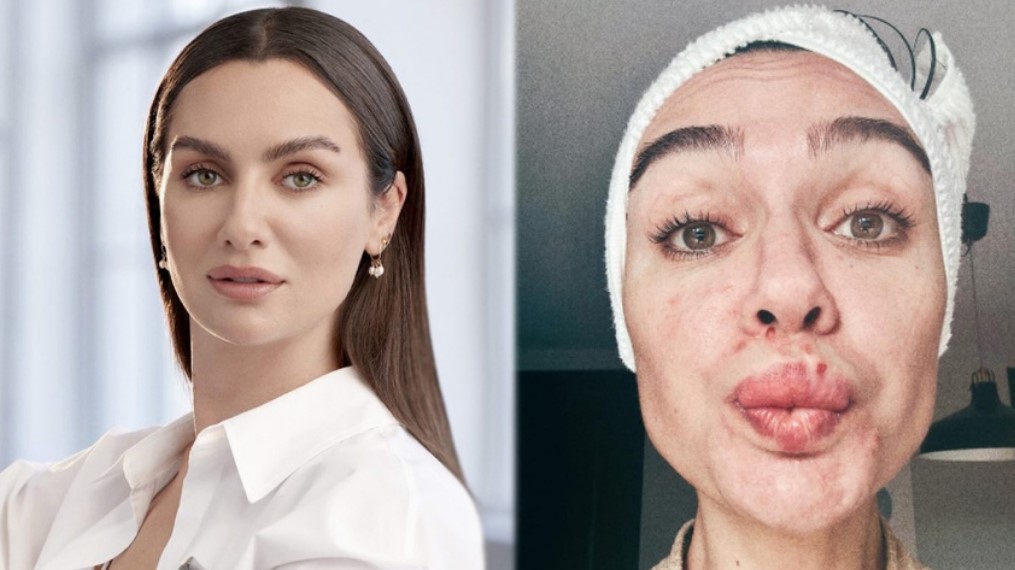 Son görüntüsü korkuttu: Birce Akalay’ın makyajsız hali şoke etti