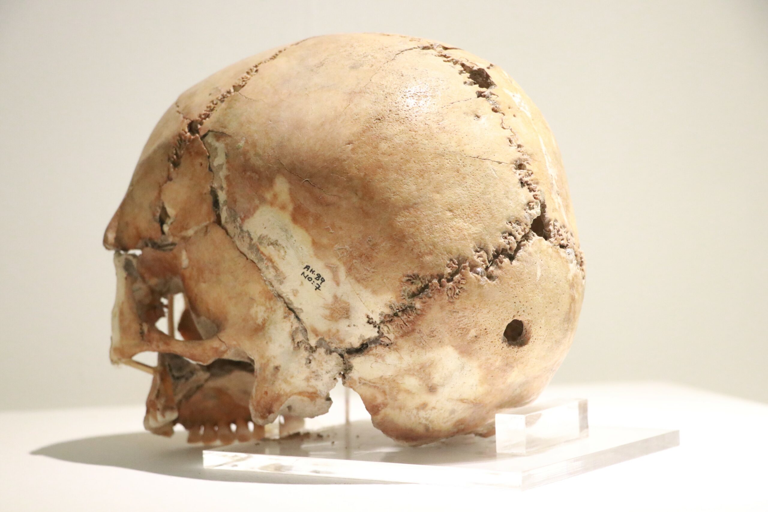 Dünyanın ilk beyin ameliyatı 10 bin 500 yıl önce Aksaray’da yapıldı