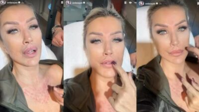 Seda Sayan yüzüne sünnet derisinden sıvı ekletti
