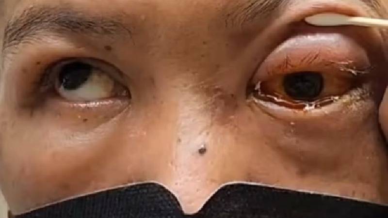 Sarhoşken yüzüstü uyuyan adam kör oldu