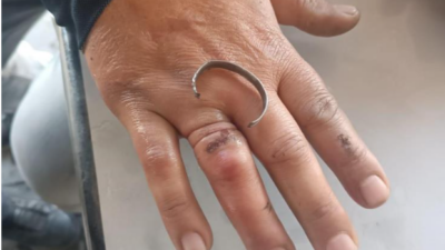 Parmağına sıkışan yüzüğü, itfaiye keserek çıkardı