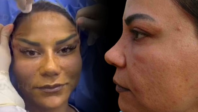 220 bin liraya estetik oldu, hayatı kabusa döndü!