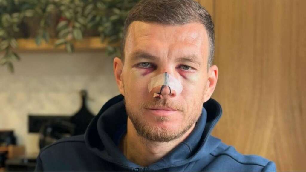 Yüzüne tekme atılan Dzeko son halini paylaştı